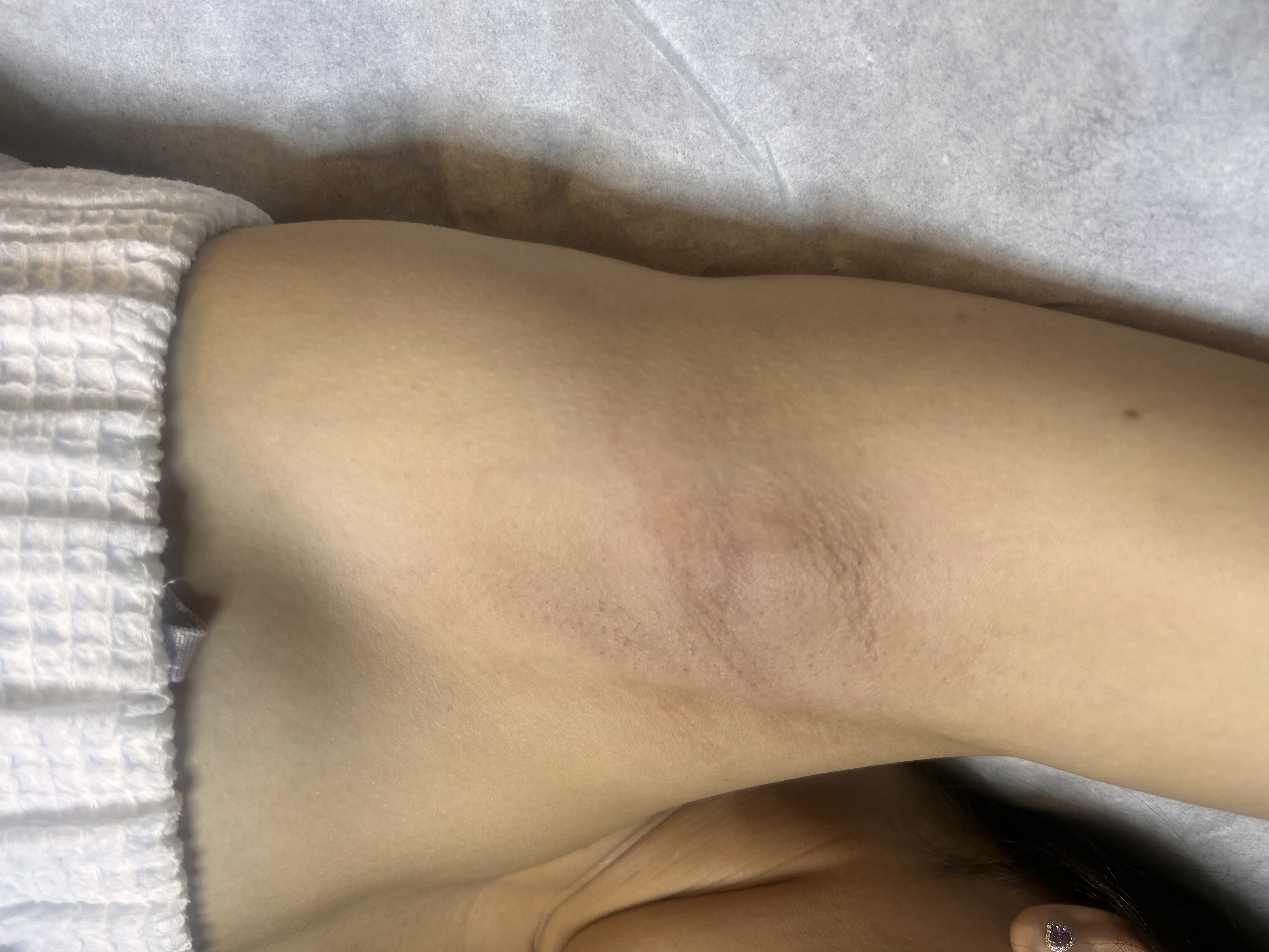 Axila después de la depilación con cera